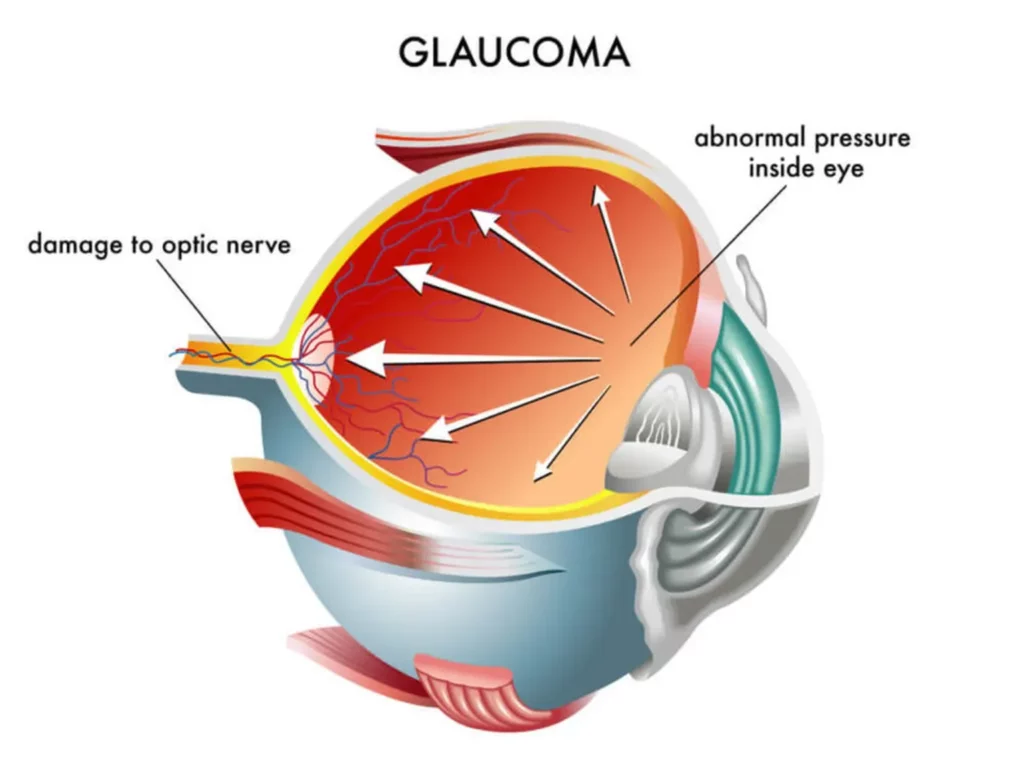 Glaucoma Diagram